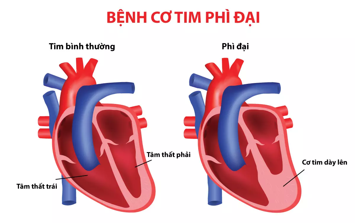 Bệnh tim to hay phì đại cơ tim làm ảnh hưởng đến chức năng bơm máu của tim.webp